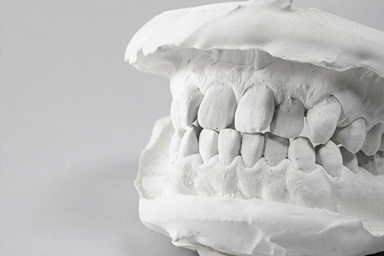 歯型データ採取